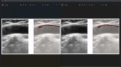 Un desarrollo de la Universidad de Cördoba y la Fundación Sadosky está usando algoritmos de análisis de imágenes para estudiar ecografías de carótidas y ayudar a la detección de riesgos cardiovasculares
