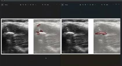Un desarrollo de la Universidad de Cördoba y la Fundación Sadosky está usando algoritmos de análisis de imágenes para estudiar ecografías de carótidas y ayudar a la detección de riesgos cardiovasculares