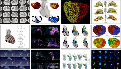 Un desarrollo del Barcelona Supercomputing Center y de ELEM Biotech permite crear un gemelo digital de un corazón y simular su funcionamiento a lo largo del tiempo, y su reacción a diversos fármacos