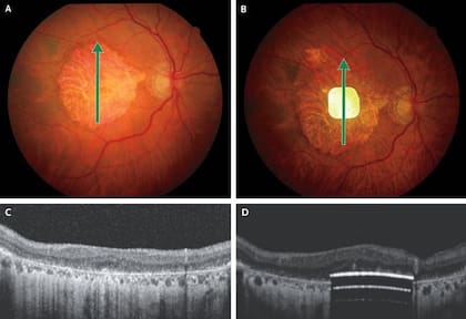 Un ejemplo del ojo de un voluntario al que se le implantó un chip PRIMA