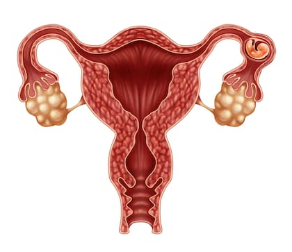 Un embarazo ectópico es aquel se produce cuando un óvulo fecundado se implanta fuera del útero