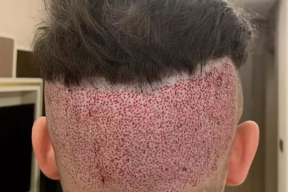 Un enorme "parche calvo" quedó en la parte de atrás de la cabeza del joven Horsfield, según su propia definición