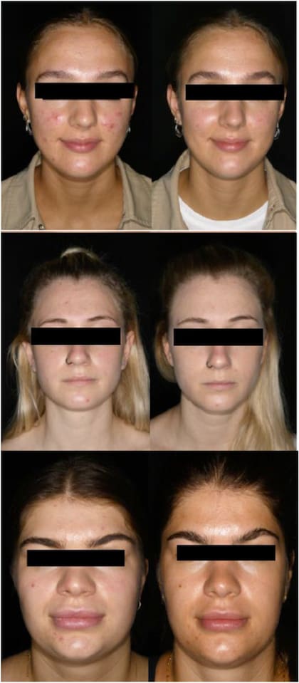 Un estudio realizado en Alemania examinó a 60 personas con acné y determinó que los suplementos de ácidos grasos omega-3 podrían ser la clave para combatir las imperfecciones en la piel de manera efectiva