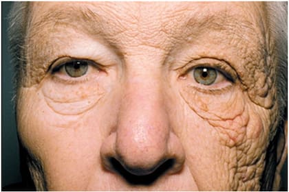 Un hombre de 69 años tiene la piel dañada del lado izquierdo de su rostro debido a la radiación solar