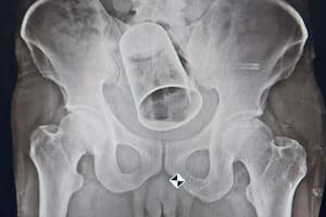 Un hombre de India fue víctima de una mala broma de sus amigos y terminó en un hospital después de descubrir un vaso de metal en el recto
