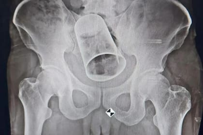 Un hombre de India fue víctima de una mala broma de sus amigos y terminó en un hospital después de descubrir un vaso de metal en el recto