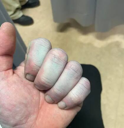 Un hombre fue llevado de urgencia al hospital después de ponerse azul