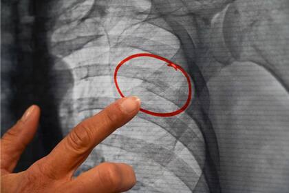 Un médico señala una radiografía de la costilla rota de una mujer que se muestra durante la exposición "La invisibilidad no es un superpoder"