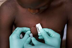 Cómo se contagia la viruela del mono, los síntomas y los casos en la Argentina