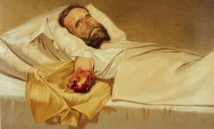 Un soldado de la Guerra Civil estadounidense con gangrena hospitalaria en el brazo (1861-65).