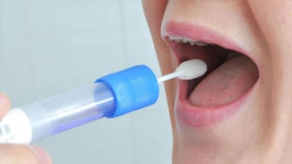 Un test de saliva puede ayudar a diagnosticar el mejor tratamiento neuropsiquiátrico