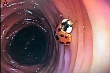 Una catarina fue encontrada en el colon de un hombre sin enfermedades preexistentes