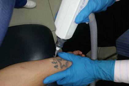 Una de las sesiones para remover tatuajes en la clínica Láser Corazón de María en El Salvador