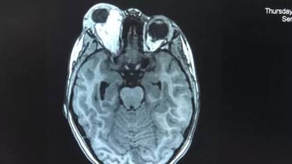 Una de las tomografías mostró cómo el ojo derecho de Yasmin (la mancha blanca a la izquierda en la imagen) sobresalía