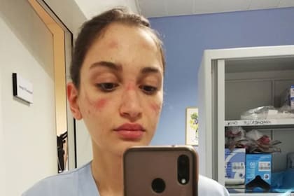 Una joven que trabaja en el sistema de salud italiano mostró su rostro después de una jornada de trabajo y contó cómo se vive el día a día.