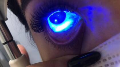 Una mancha blanca en el ojo de Adne revela una lesión que tenía