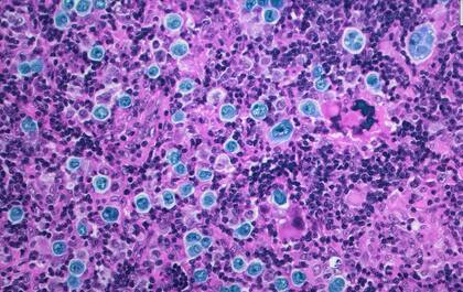 Una micrografía de luz a color de una sección de una biopsia de ganglio linfático de un paciente con linfoma difuso de células B grandes, que muestra células grandes anormales diseminadas de manera difusa