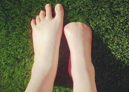 Una mujer australiana sufrió la amputación de los dedos de sus pies tras someterse a un tratamiento con peces