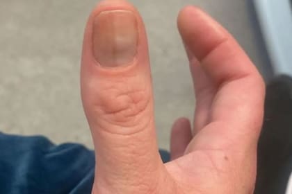 Una mujer de Escocía se realizó una biopsia al enterarse de una mancha maligna debajo de sus uñas