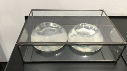 Una mujer donó los implantes de silicona que se puso años atrás a petición de su pareja