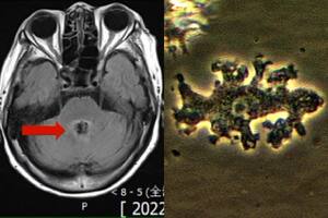 El impensado cambio de diagnóstico que aterró a una paciente: “Ameba come cerebros”