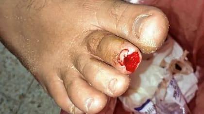 Una niña de 12 años que sufrió una mordedura en un dedo del pie derecho