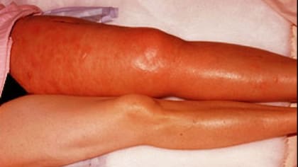 Una paciente, afectada por una trombosis severa en una de sus piernas