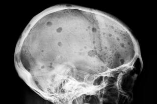 Avanza un tratamiento para un cáncer mortal: "Es la primera vez que hablamos seriamente de curación"