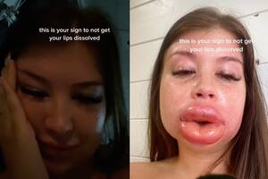 Se hizo un tratamiento en los labios y el resultado la devastó: “Estoy atormentada”