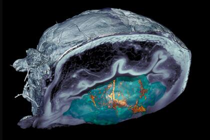 Una vejiga en la que se puede ver la acumulación de nanorrobots que atacan al tumor