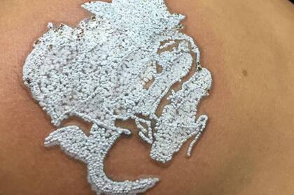 Una vez finalizada la sesión, se aplica pomada antibiótica y se cubre la zona tratada con una cura oclusiva