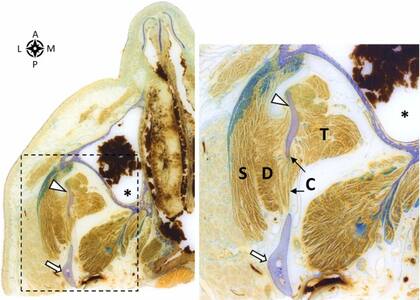 Una vista inferior de una sección transversal incrustada en la mandíbula medial