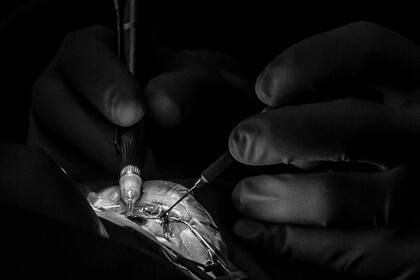 Unas 450 personas de diferentes localidades de Salta fueron operadas de cataratas durante cuatro días por un equipo de 50 profesionales en el Hospital materno infantil