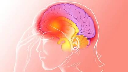 Uno de los desafíos de estudiar la migraña es la amplia gama de síntomas que puede presentar