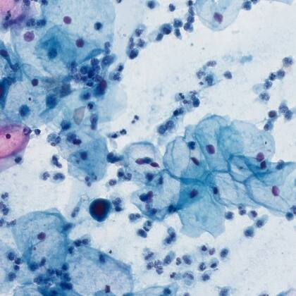 Uno de los miniparches con imágenes celulares digitalizadas para entrenar el modelo de IA para el Proyecto PAPS