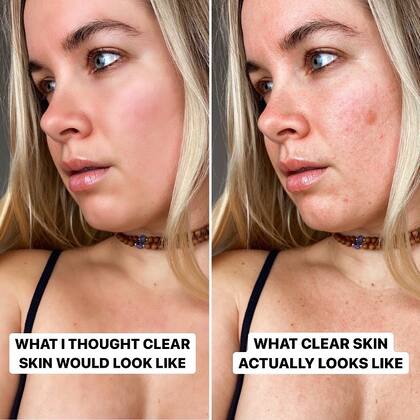 Uno de los recientes posteos de la influencer británica hacen hincapié en la aceptación de las imperfecciones de la piel