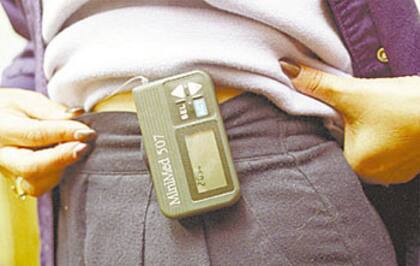 Una bomba de insulina, que se lleva en el cinturón y gestiona el equilibrio adecuado de glucosa en el cuerpo