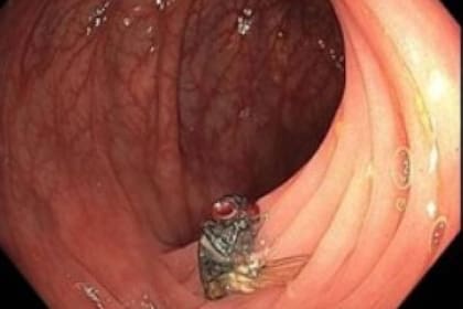 Unos médicos encontraron una mosca pegada en el colon de un hombre