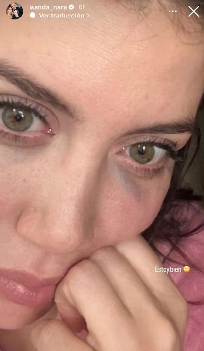 Wanda terminó con un moretón en la parte inferior del ojo