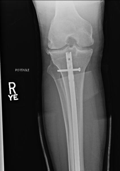 Weidman se rompió, además de la tibia, el peroné