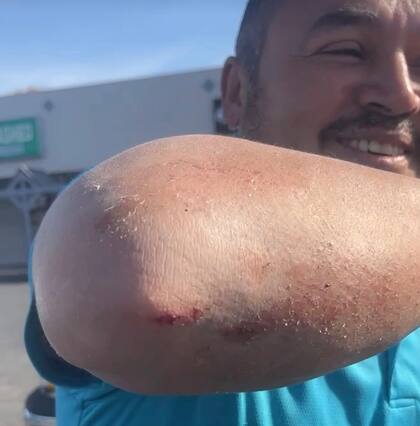 Willy Aceituno sufrió heridas en sus brazos debido al forcejeo con los agentes del ICE