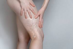 Woman shows leg with varicose veins. The concept of human health and disease. Gray background.