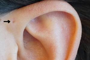 ¿Por qué algunas personas tienen un orificio en la parte superior de la oreja?