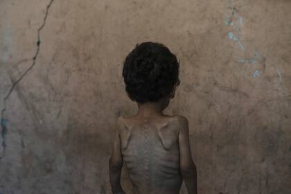 Yazan Abu Ful, un niño de 2 años malnutrido, posa para una foto en la casa de su familia en el campo de refugiados de Shati, en Ciudad de Gaza, el miércoles 23 de julio de 2025. (AP Foto/Jehad Alshrafi)