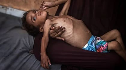 Yezen Abu Ful, de 2 años, lucha por sobrevivir en el campo de refugiados de Al-Shati en el norte de Gaza