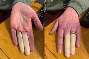 Los dedos de la mujer pueden ponerse blancos o violetas por el frío o el estrés