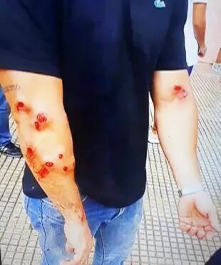 Heridos por balas de goma