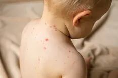 Cuáles son los síntomas del sarampión y en qué se diferencian de la varicela
